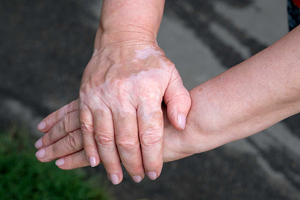 How to check vitiligo yourself？