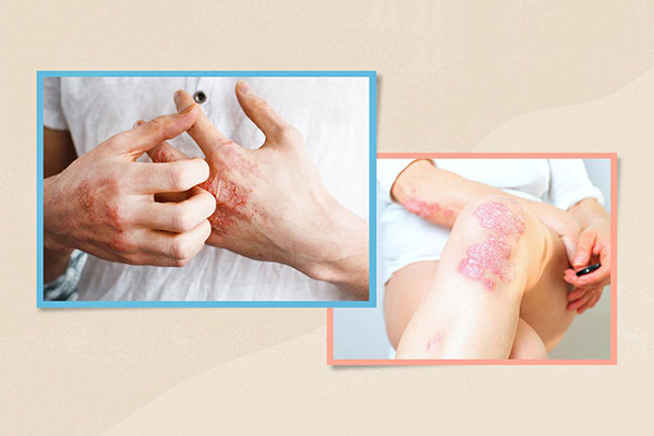 Psoriasis is cured, how to remove the pigmentation left ?