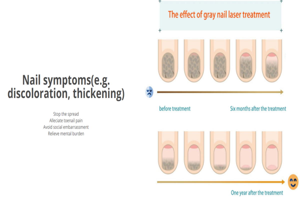 Bye Bye, Fungi! The Efficacy of Red Light Therapy for Nail Fungus