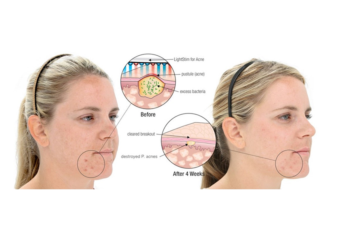 LED Light Therapy for Acne Treatment