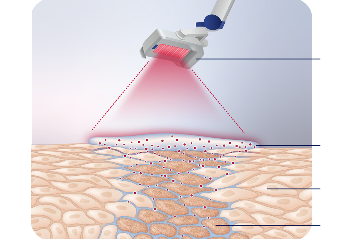 The Unique Role of phototherapy in Winter