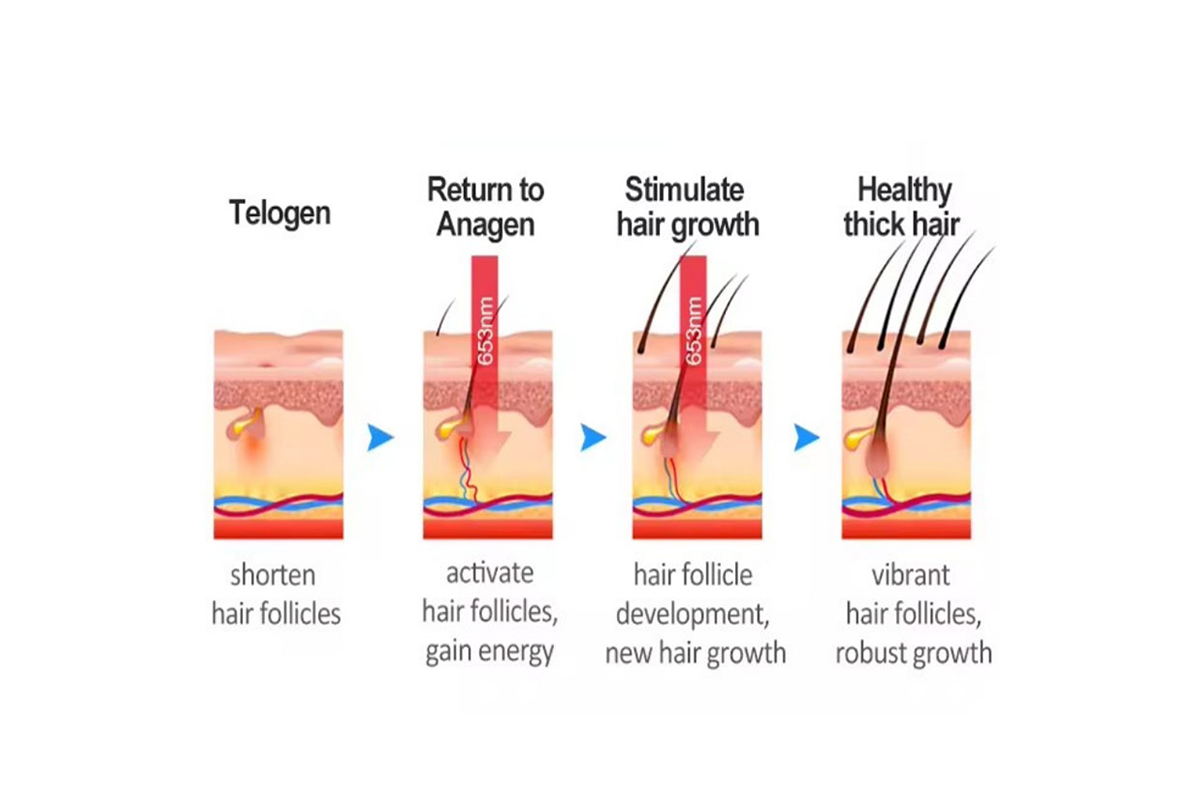 Research and application of red and blue light in the treatment of alopecia areata and hair loss