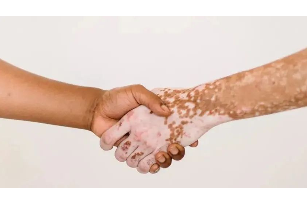 Why Can Chemical Vitiligo Potentially "Self-Heal"?