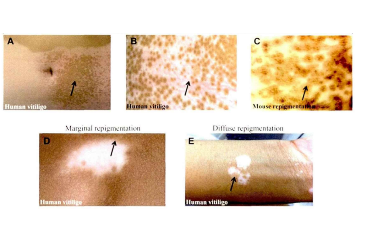 Hands and feet, white hair area white spot stubborn difficult to treat, what is the reason?