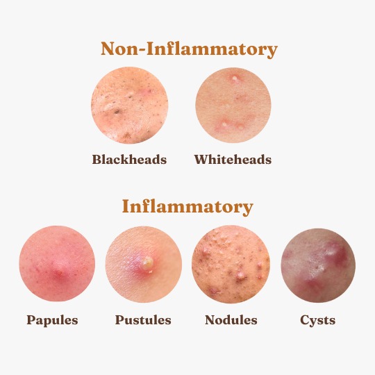 Managing Acne in Teenagers