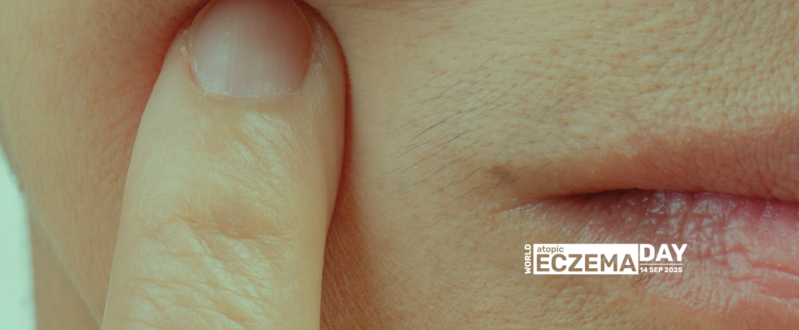 atopic eczema